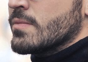 trasplante-barba